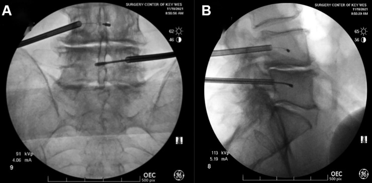 BVN ablation — AP and lateral views during procedure