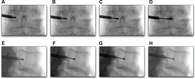 BVN ablation — fluoroscopic-guided transpedicular approach