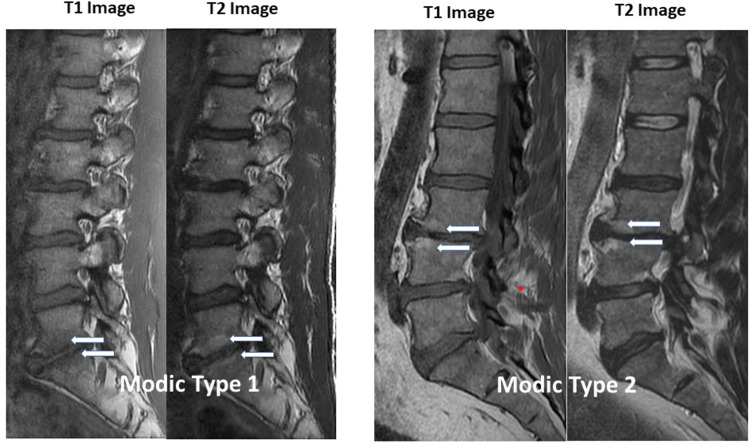 Modic Type 1 vs Type 2 changes on MRI