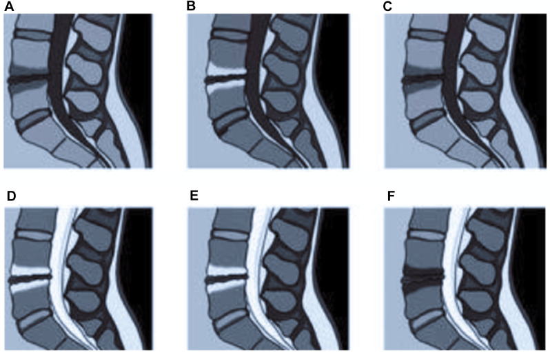 Modic Types 1, 2, and 3 — schematic diagram