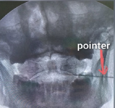 C1-2 joint — AP fluoroscopic landmark identification