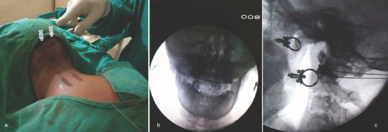 C1-2 injection — patient positioning and bilateral needle placement