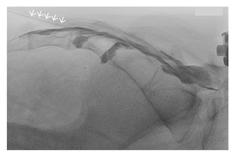 Caudal epidural injection under fluoroscopy