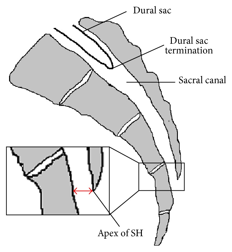 Caudal approach — sacral hiatus sagittal view