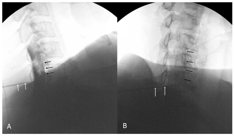 Cervical interlaminar — lateral and CLO views