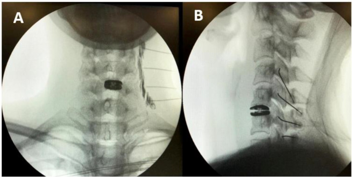 Cervical radiofrequency ablation under fluoroscopy