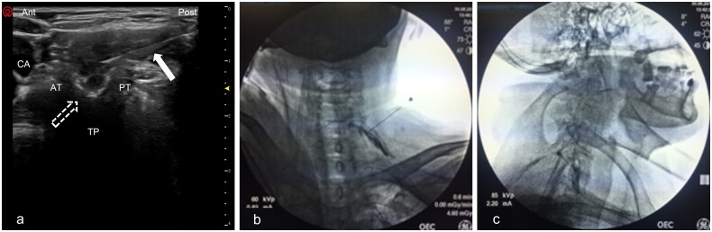 Cervical transforaminal ESI — AP and lateral views