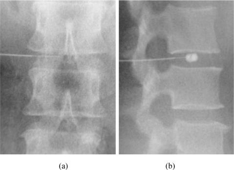 Provocative discography — needle positioning under fluoroscopy