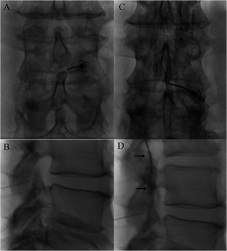 Epidural contrast spread pattern — AP and lateral