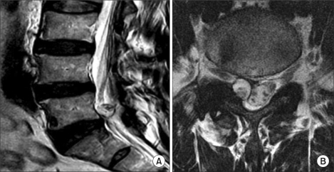 Synovial cyst on MRI — sagittal and axial views