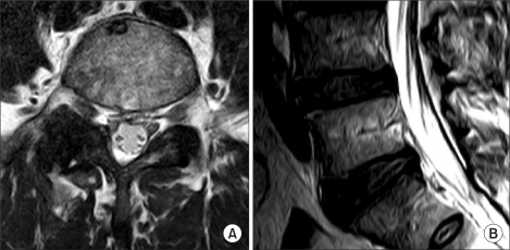 Follow-up MRI showing cyst resolution