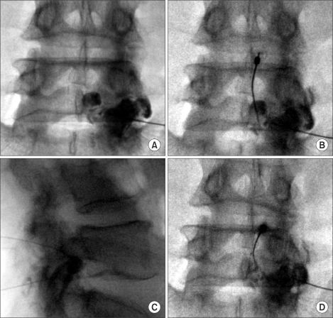 Fluoroscopic-guided synovial cyst rupture
