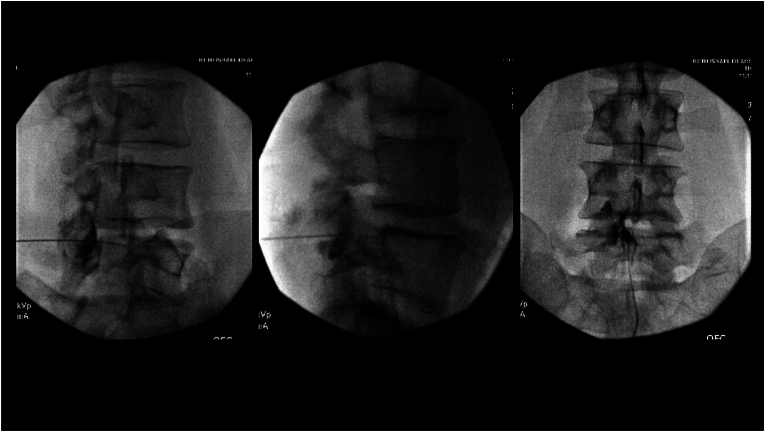 False loss-of-resistance — non-epidural contrast pattern