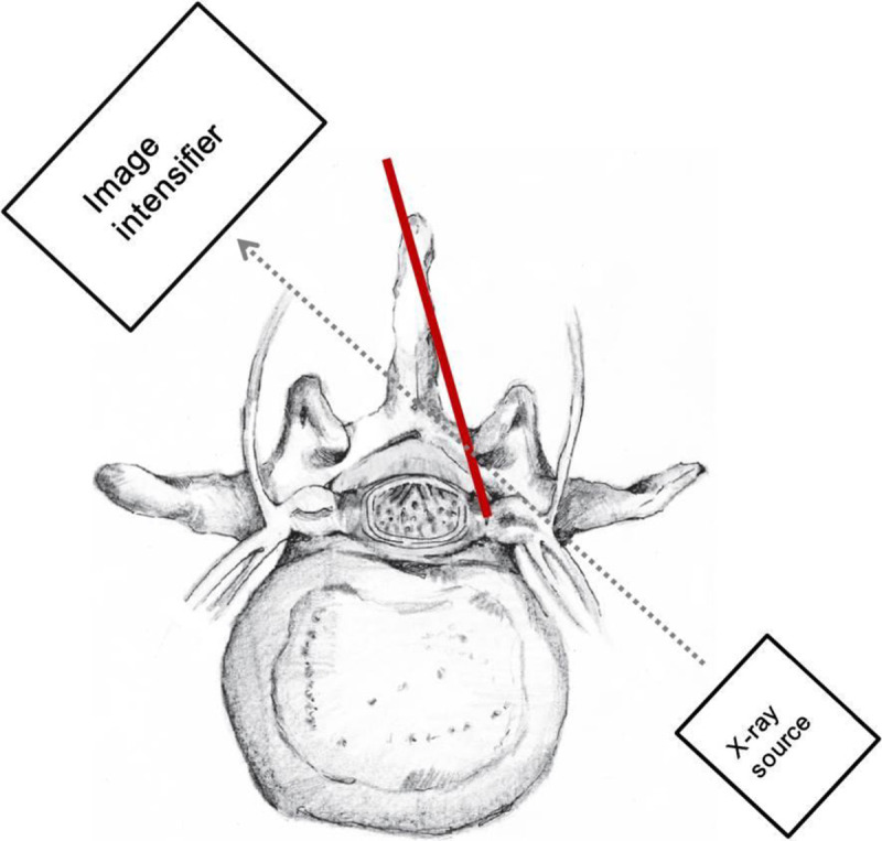 Contralateral oblique (CLO) view technique