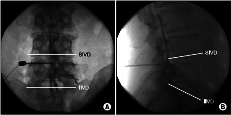 Interlaminar epidural — AP and lateral fluoroscopic views