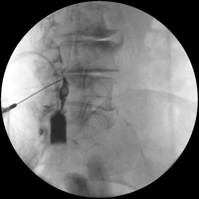 Loss of resistance technique — epidural confirmed with contrast