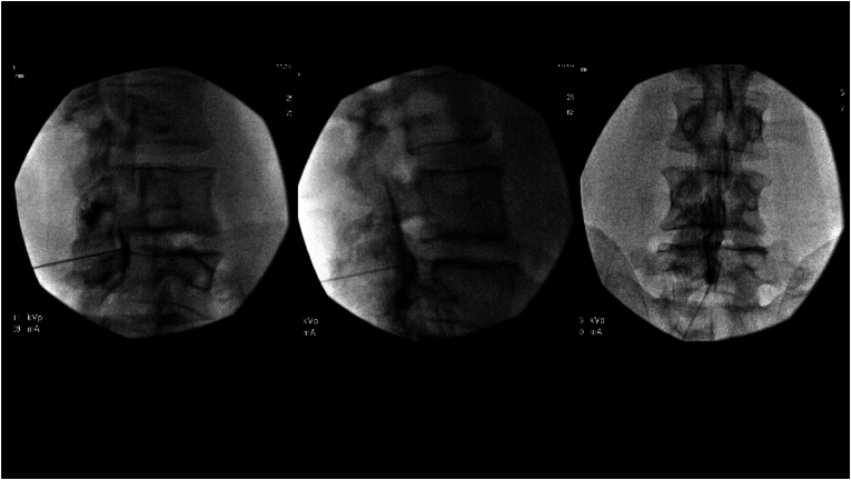 True epidural contrast spread — CLO, lateral, AP comparison