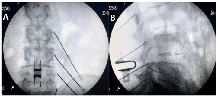 Lumbar radiofrequency ablation under fluoroscopy