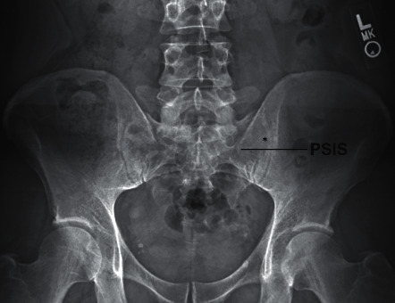 SI joint injection — AP fluoroscopic view