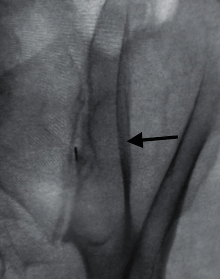 SI joint injection — oblique view with needle