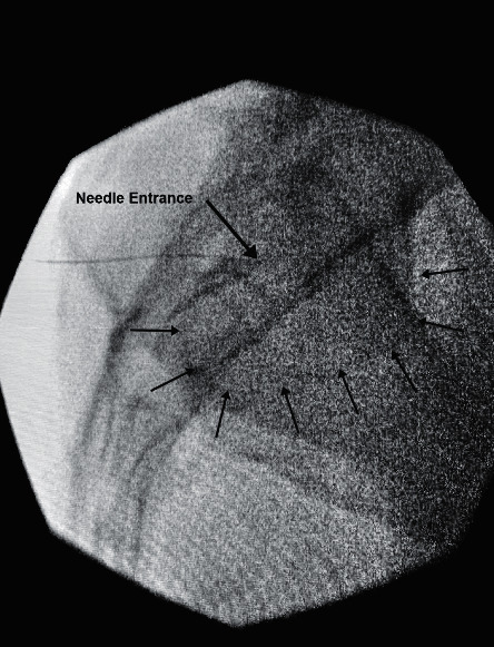 SI joint arthrogram — contrast within joint