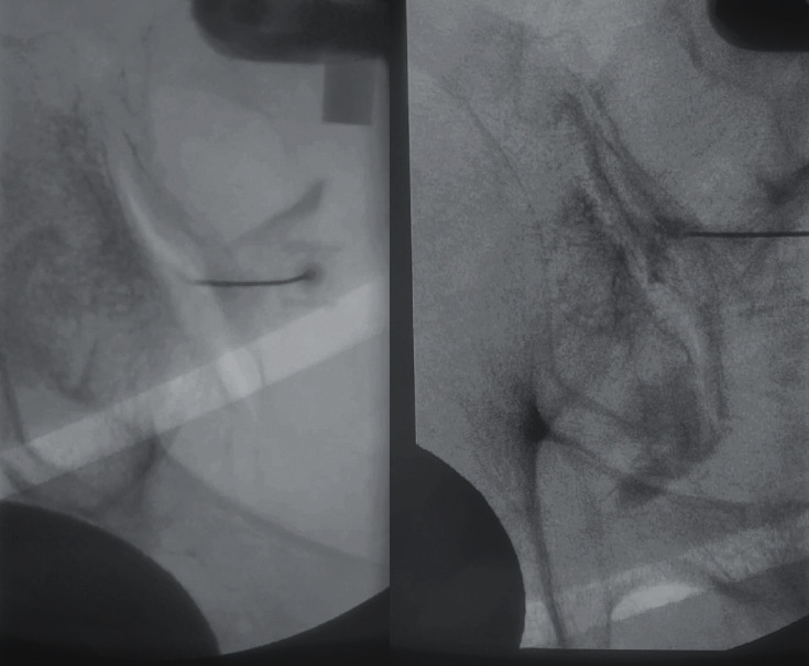 SI joint injection — lateral confirmation