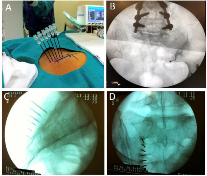 SI joint lateral branch RFA