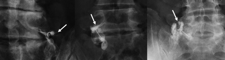 Selective nerve root block — three contrast pattern types