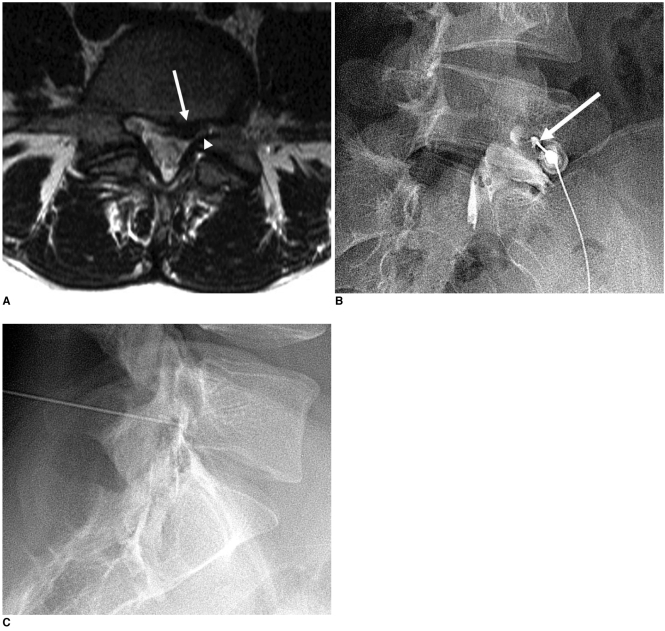 L5-S1 selective nerve root block — oblique and AP views
